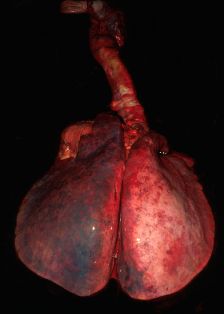 Congestión pulmonar y petequias