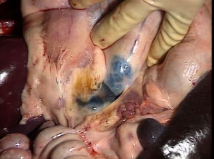 Ganglio linfático infartado y hemorrágico