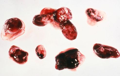 Ganglios linfáticos infartados y hemorrágicos