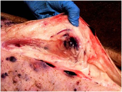 Hematoma y necrosis en tejidos subcutáneos