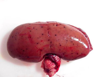 Hemorragias renales (2).