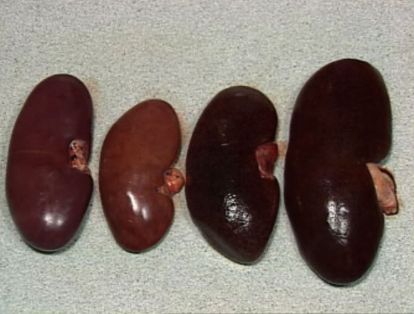 Riñon aumentado de tamaño y congestivo