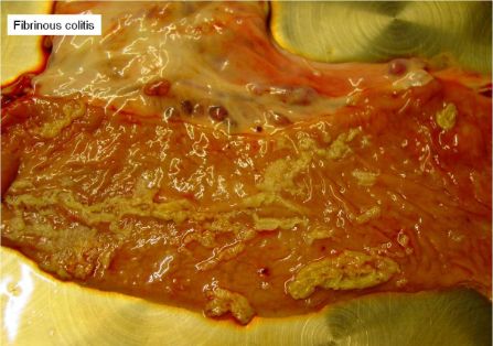 Colitis fibrinosa