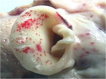 Hemorragias en la glotis