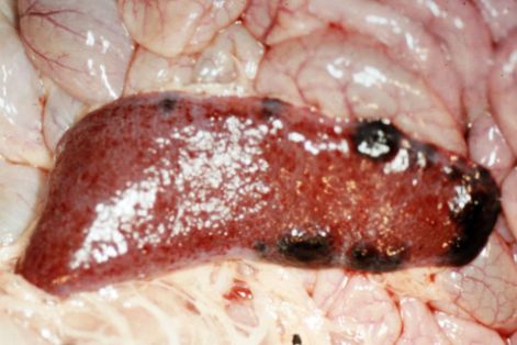 Infartos apicales en bazo