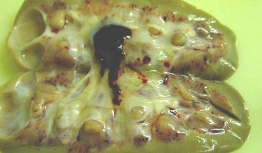 Petequias y equimosis en parénquima renal